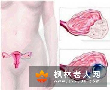 卵巢囊肿会给女性带来哪些危害