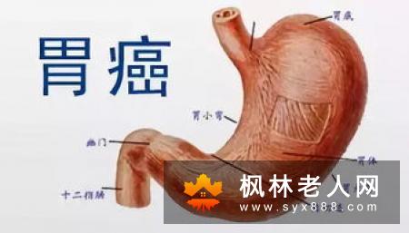 卵巢癌晚期的症状有哪些?