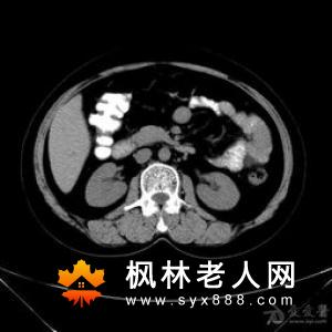 腹部疼痛当心卵巢囊肿的侵袭