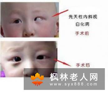 白内障手术的目的有哪些？