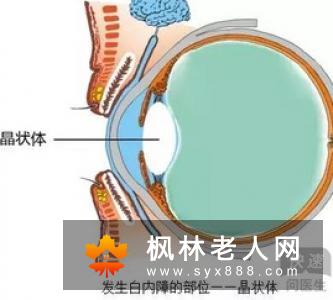 白内障的治疗及手术