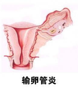 排卵前白带增多怎么办？5种情况下白带增多属于正常情况