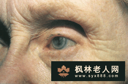 白内障
