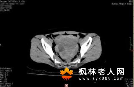 卵巢黄体破裂的症状有哪些
