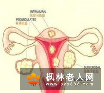 卵巢囊肿的日常护理措施包括哪些