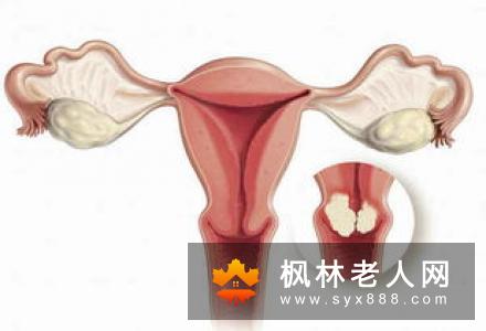 卵巢囊肿的治疗需要及时和正确