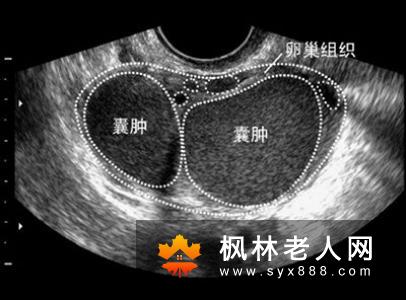 卵巢囊肿什么情况下需要做手术呢