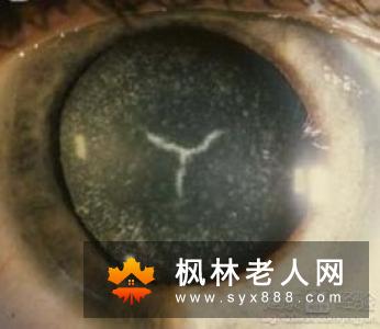 白内障的治疗及手术