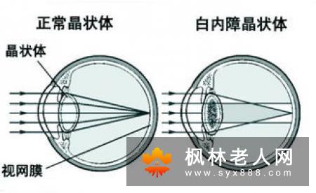两大白内障的护理方法推荐