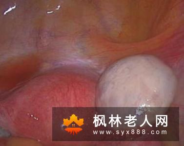 如何治疗多囊卵巢综合