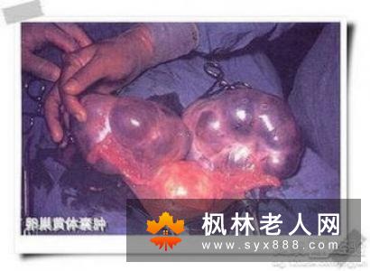 卵巢囊肿手术治疗后的注意事项