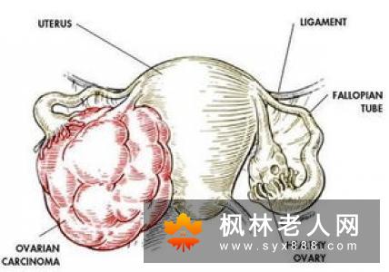 卵巢囊肿有哪些早期症状