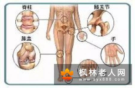 膝骨关节炎的老人不宜过度散步“遛弯”