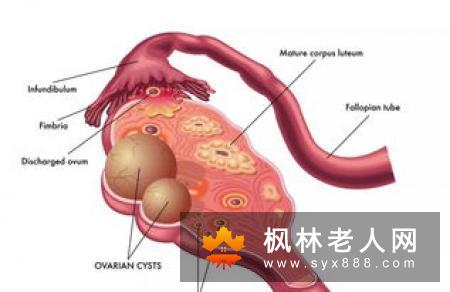 患上卵巢囊肿该注意什么