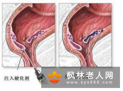 怎么预防痔疮打太极拳能防治痔疮吗