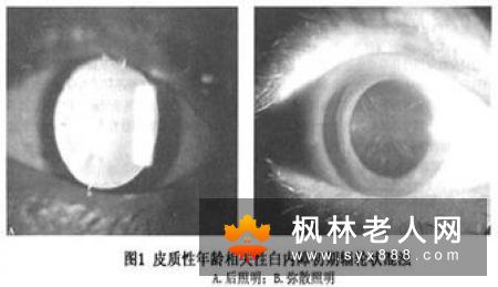 白内障早期症状有哪些？