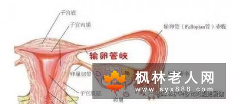 输卵管通畅闭塞的治疗