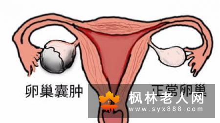 临床上卵巢囊肿患者有哪些典型发病信号
