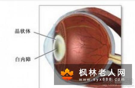 白内障初期的六大症状