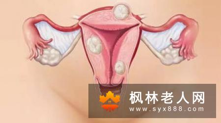 卵巢囊肿对女性朋友有哪些危害