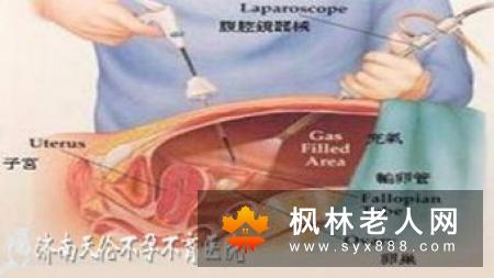 输卵管通液的副作用