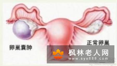 卵巢囊肿患者会出现哪些不适症
