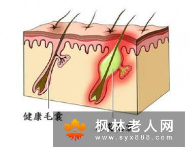 高血压引起女性睡觉打呼噜的原因介绍