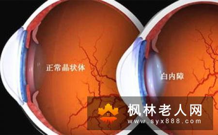 白内障的临床表现会是什么呢