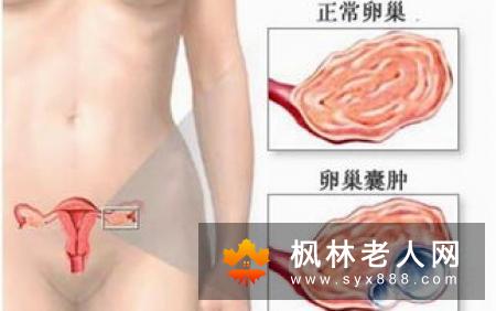 女性患上卵巢囊肿后应该怎么治