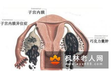 女性患有卵巢囊肿会不会影响排卵呢