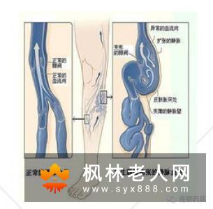 小编告诉你什么是右侧卵巢巧克力囊肿？