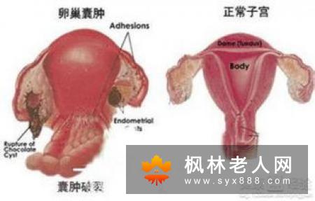 卵巢畸胎瘤治疗后复发问题