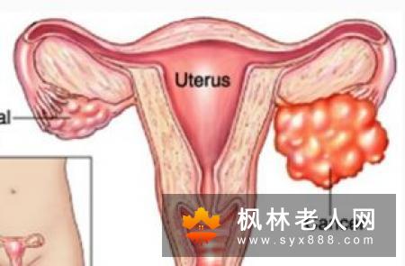 卵巢癌的5大早期症状