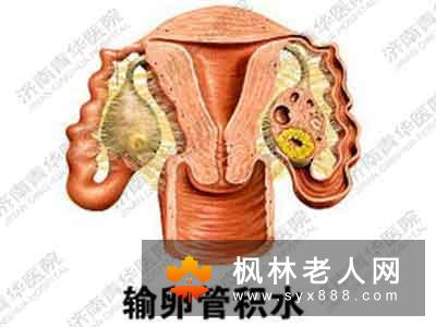 输卵管积水可以治愈吗
