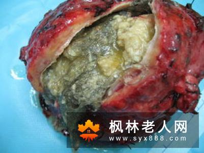 卵巢未成熟畸胎瘤食疗方法