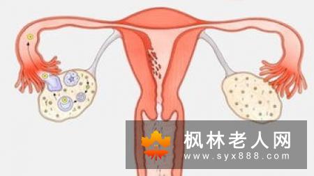卵巢囊肿有哪些特点