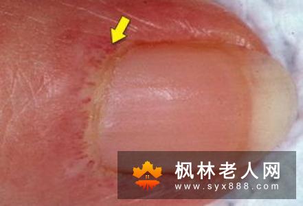 了解皮肤病的症状 关注皮肤健康问题