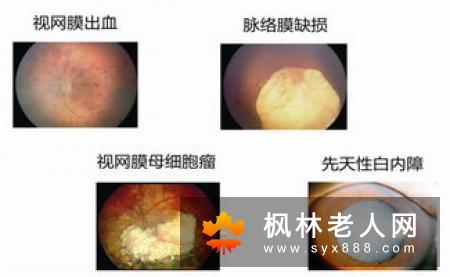 先天性白内障要及早治疗