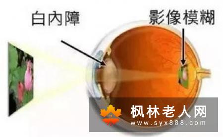 关注白内障患者年轻化