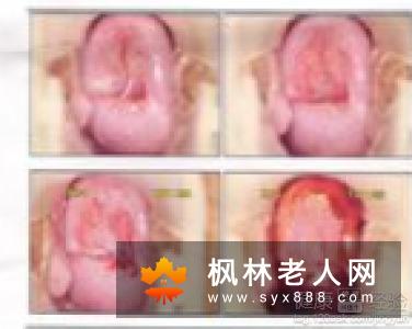 老年人检查是宫颈息肉怎么办？