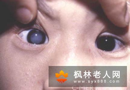 两种手术摘除术治疗白内障