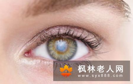先天性白内障的临床表现