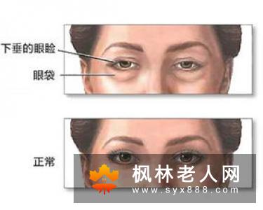 白内障真的愈了吗