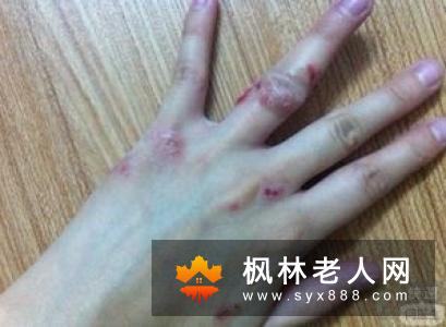 造成老年痴呆的病因是什么？