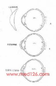 白内障的治疗详解
