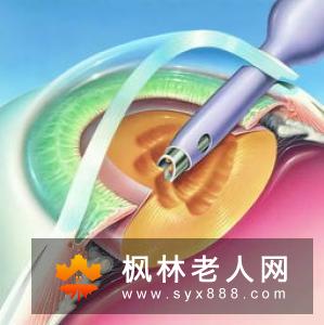关于白内障 你了解多吗?
