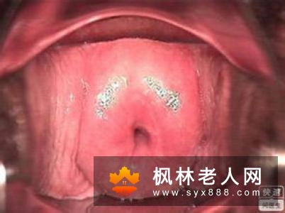 老年人检查是宫颈息肉怎么办？