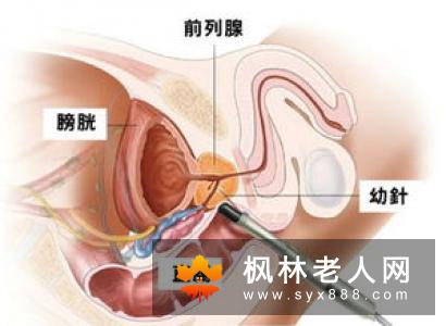 老年痴呆的具体病因是什么？