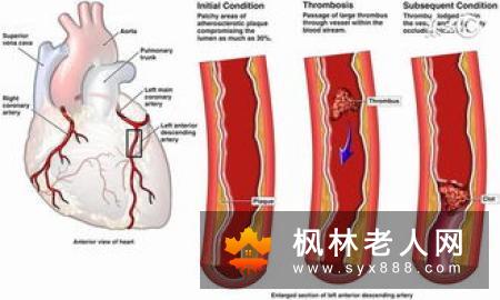 老人出现血栓有哪些信号