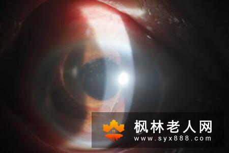 人工晶体植入治疗白内障有那些特点